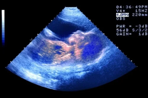 Bebê nasce de embrião congelado há 30 anos e bate recorde mundial