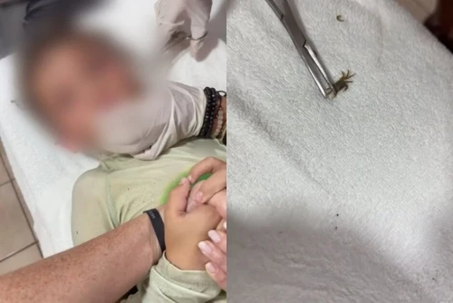 VÍDEO: Menino surpreende médicos ao ter caranguejo vivo retirado do ouvido após mergulho no mar
