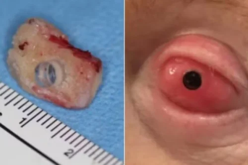 Cego volta a enxergar após ter dente implantado no olho em cirurgia inédita