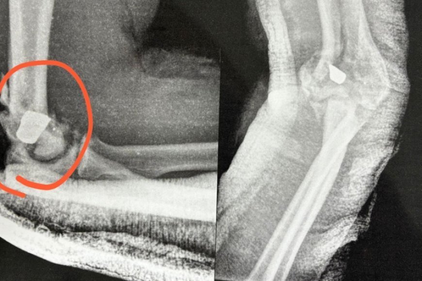 Cantor gospel está com bala no braço e fará cirurgia de risco; veja raio-X