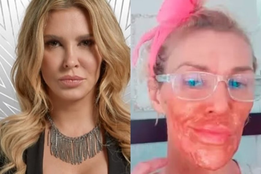 Ex-modelo sofre queimaduras graves ao tentar eliminar parasita no rosto com método caseiro