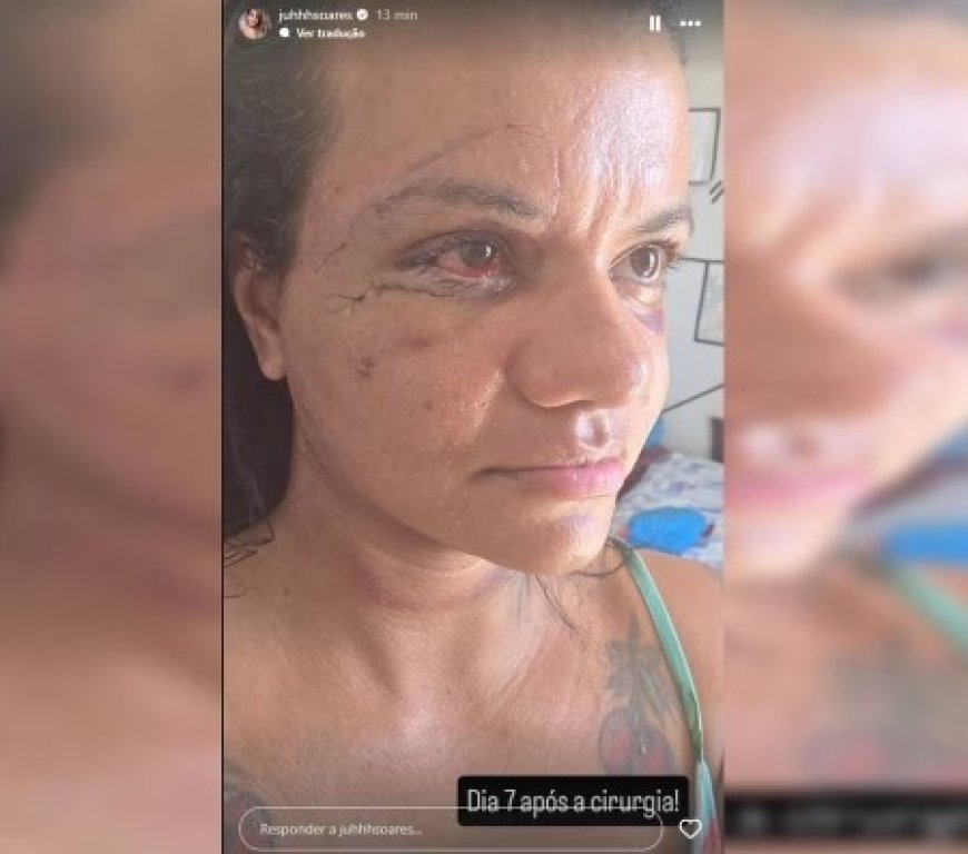 Mulher que foi agredida com 60 socos por ex-namorado mostra como ficou o rosto após cirurgia; Veja